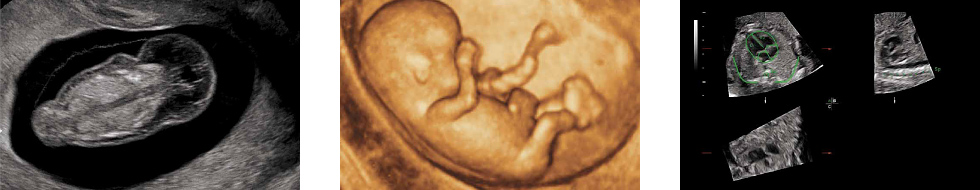 Узи Рязань беременность: 10 недель беременности